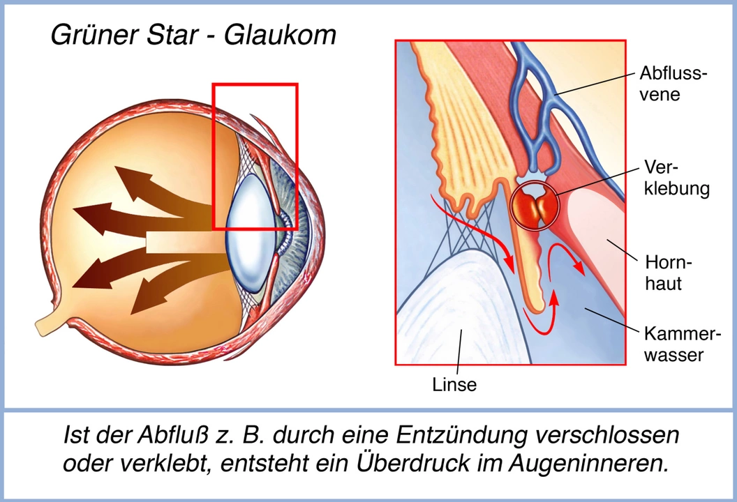 Betaxolol för glaukom: En närmare titt på dess verkningsmekanism
